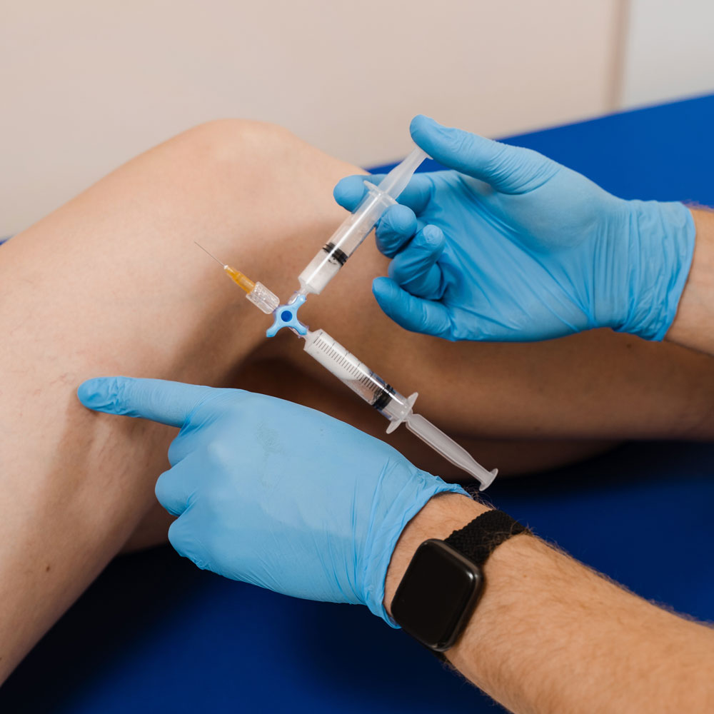 Procedimento de Escleroterapia com Espuma Densa